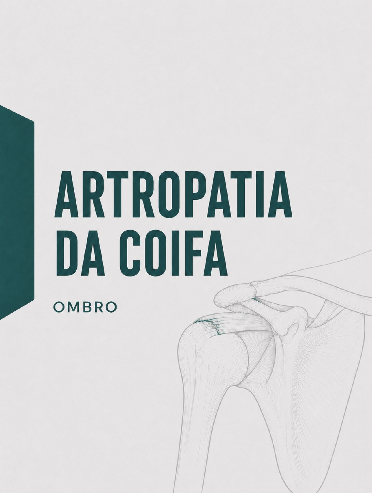 Ilustração médica de artropatia degenerativa associada a rotura maciça da coifa dos rotadores