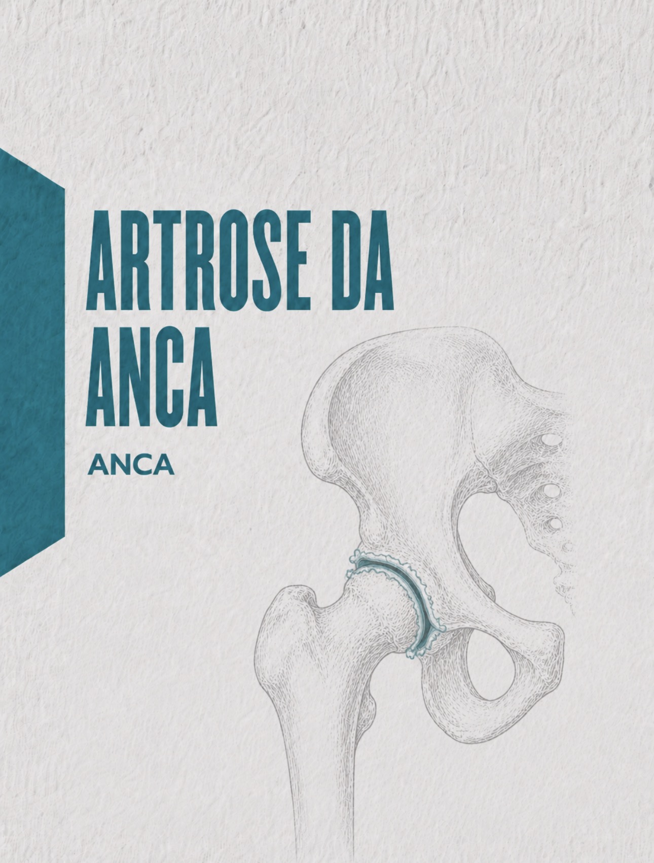 Ilustração médica de artrose da anca com perda de espaço articular coxofemoral