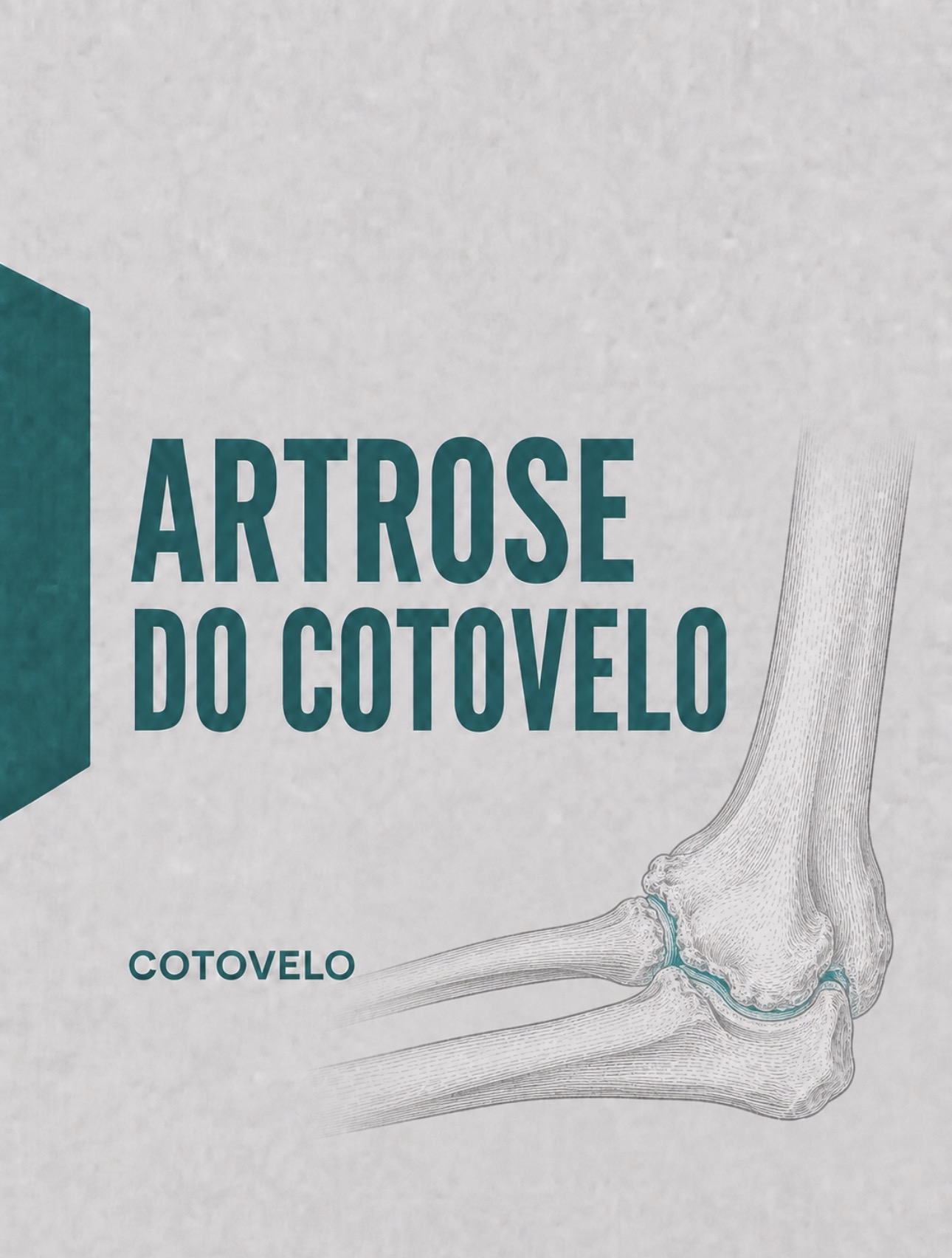 Ilustração médica de artrose e osteófitos na articulação do cotovelo