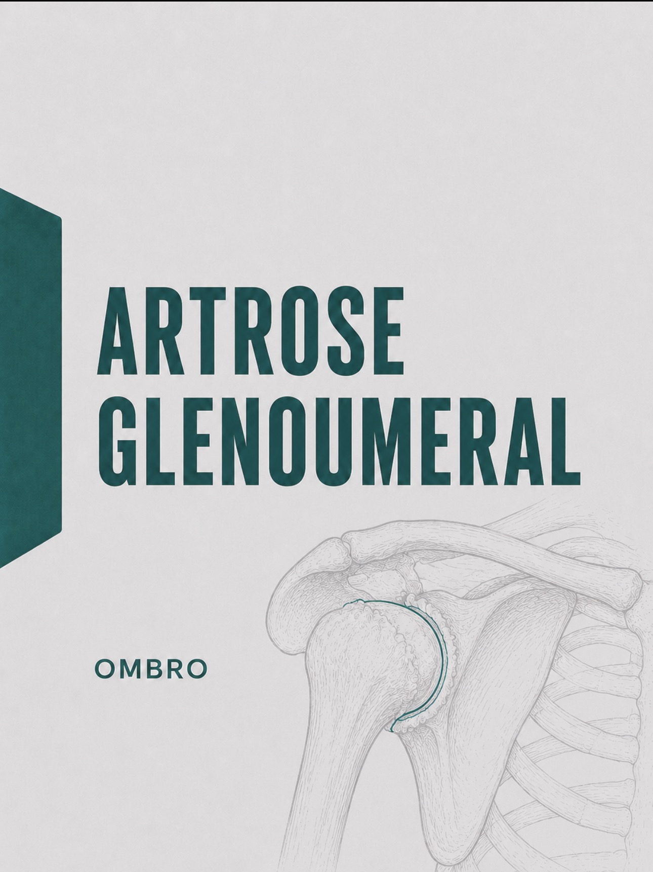 Ilustração médica de artrose glenoumeral com desgaste da cartilagem da cabeça do úmero e glenoide