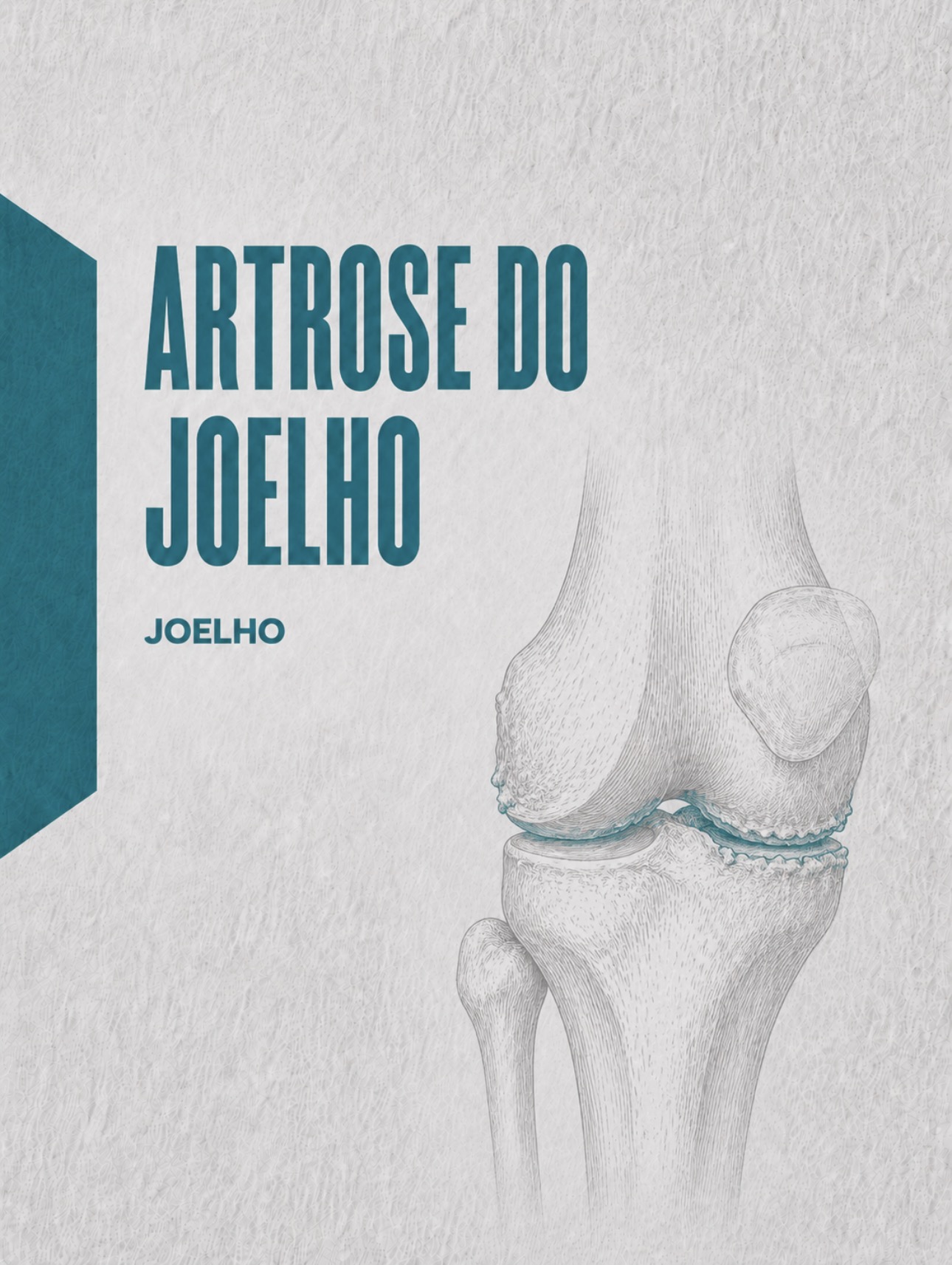 Ilustração médica de artrose femorotibial e femoropatelar do joelho