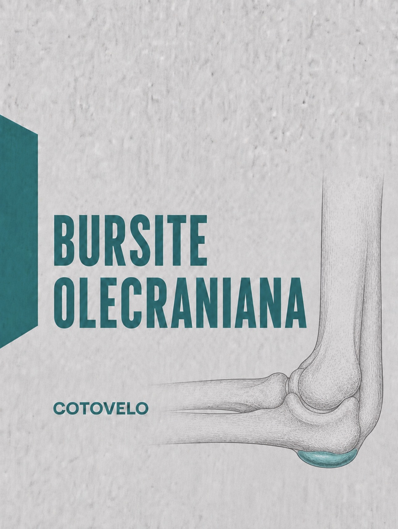 Ilustração médica de bursite olecraniana com distensão da bursa sobre o olecrânio