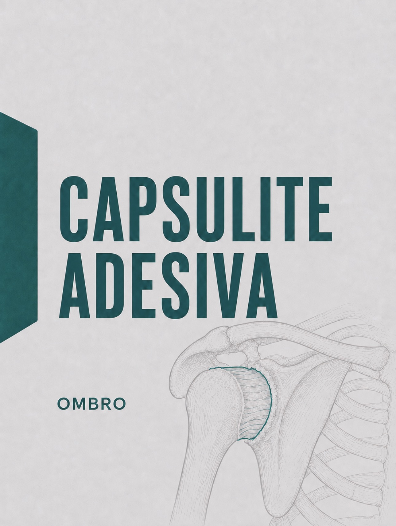 Ilustração médica de capsulite adesiva com espessamento e retração da cápsula articular do ombro