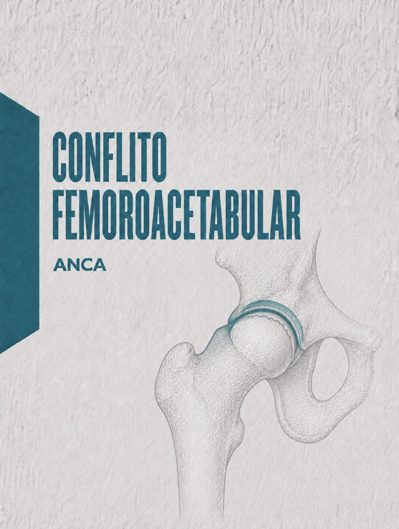 Ilustração médica de morfologia cam e pincer no conflito femoroacetabular