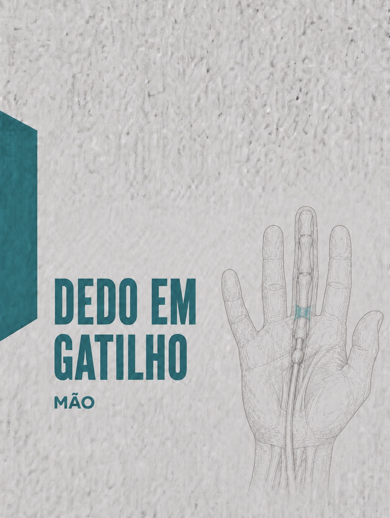 Ilustração médica da polia A1 e conflito do tendão flexor no dedo em gatilho