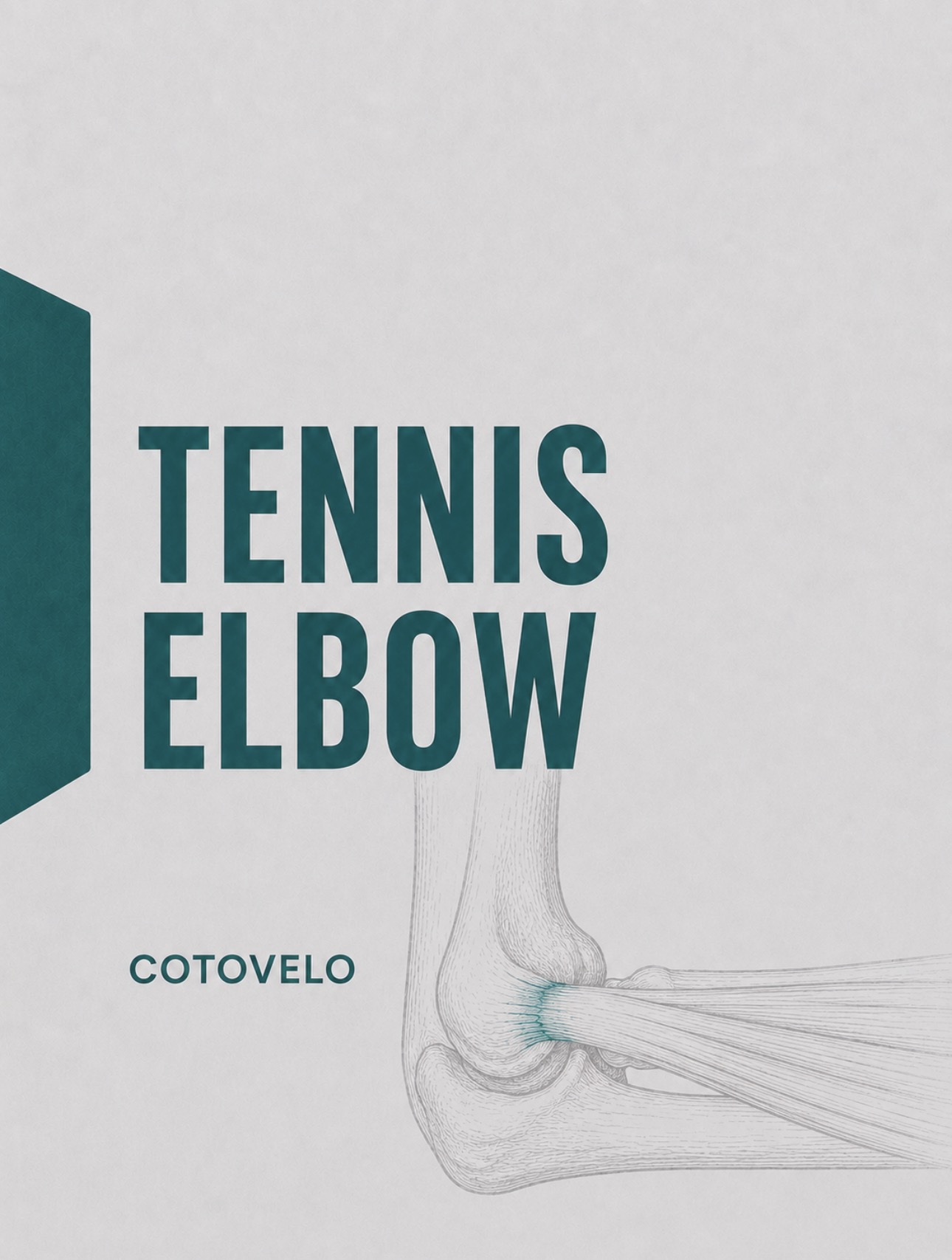 Ilustração médica da inserção extensora comum no epicôndilo lateral (tennis elbow)
