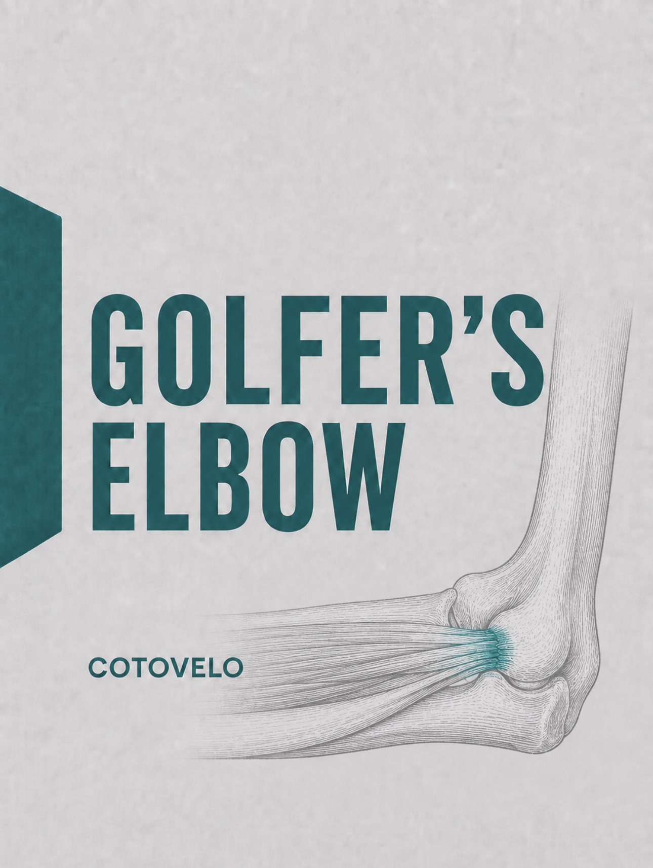 Ilustração médica da inserção flexora comum no epicôndilo medial (golfer's elbow)