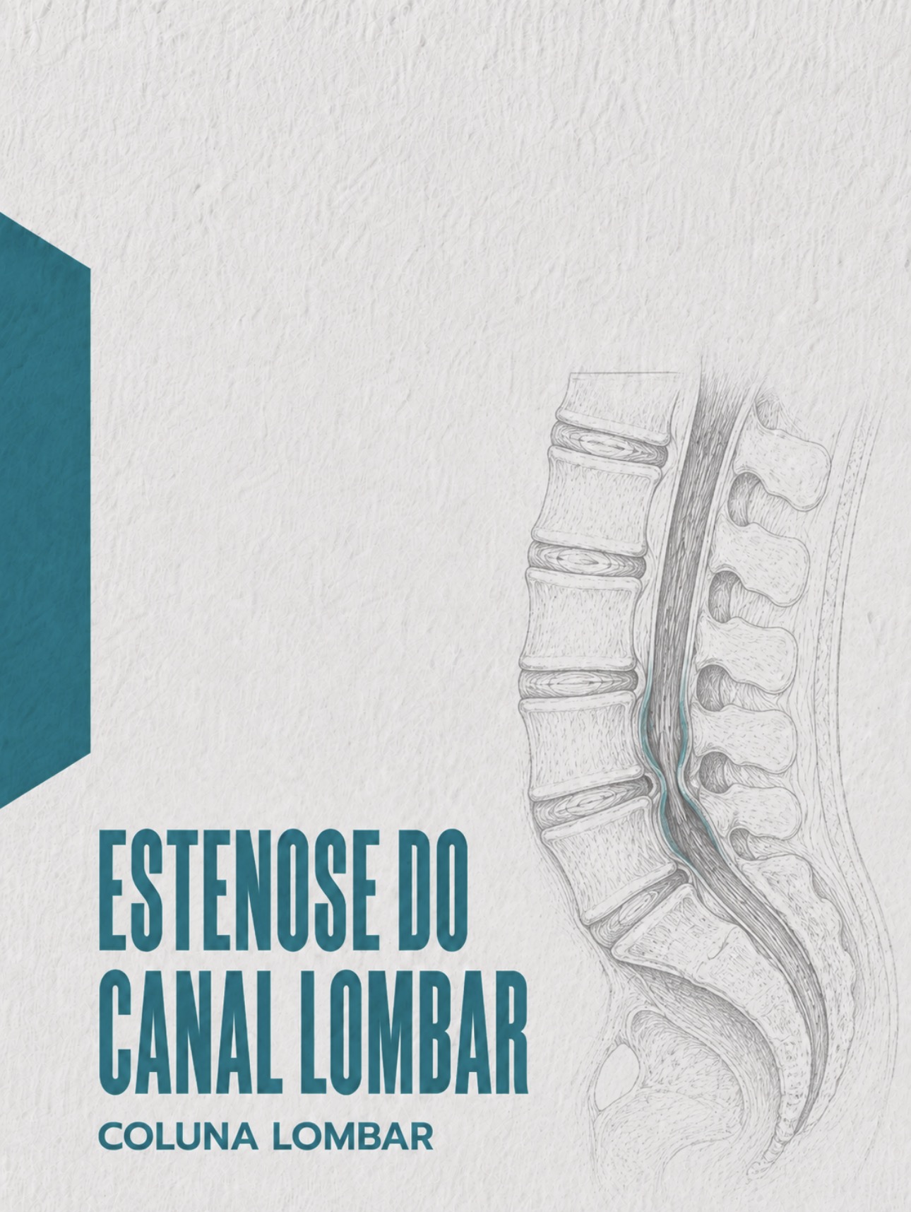Ilustração médica de estenose e estreitamento do canal vertebral lombar