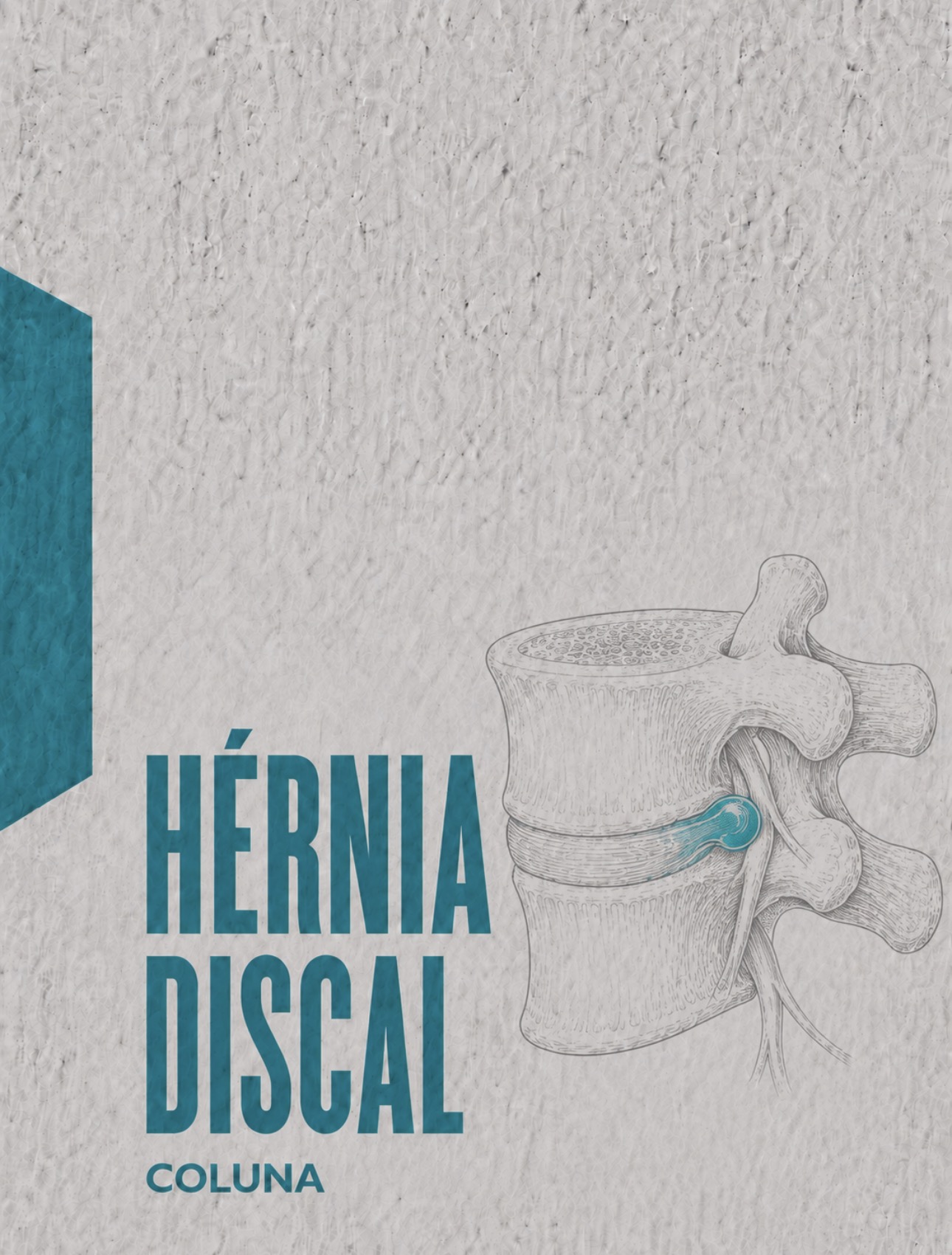 Ilustração médica de hérnia discal com protusão do núcleo pulposo e relação com raiz nervosa