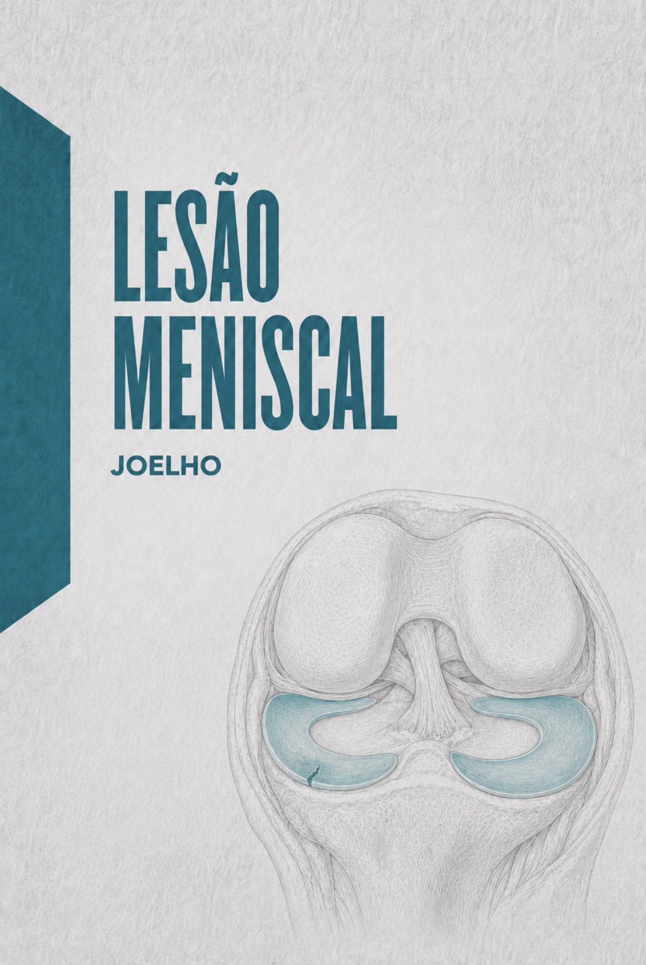 Ilustração médica dos meniscos interno e externo do joelho e planos de rotura