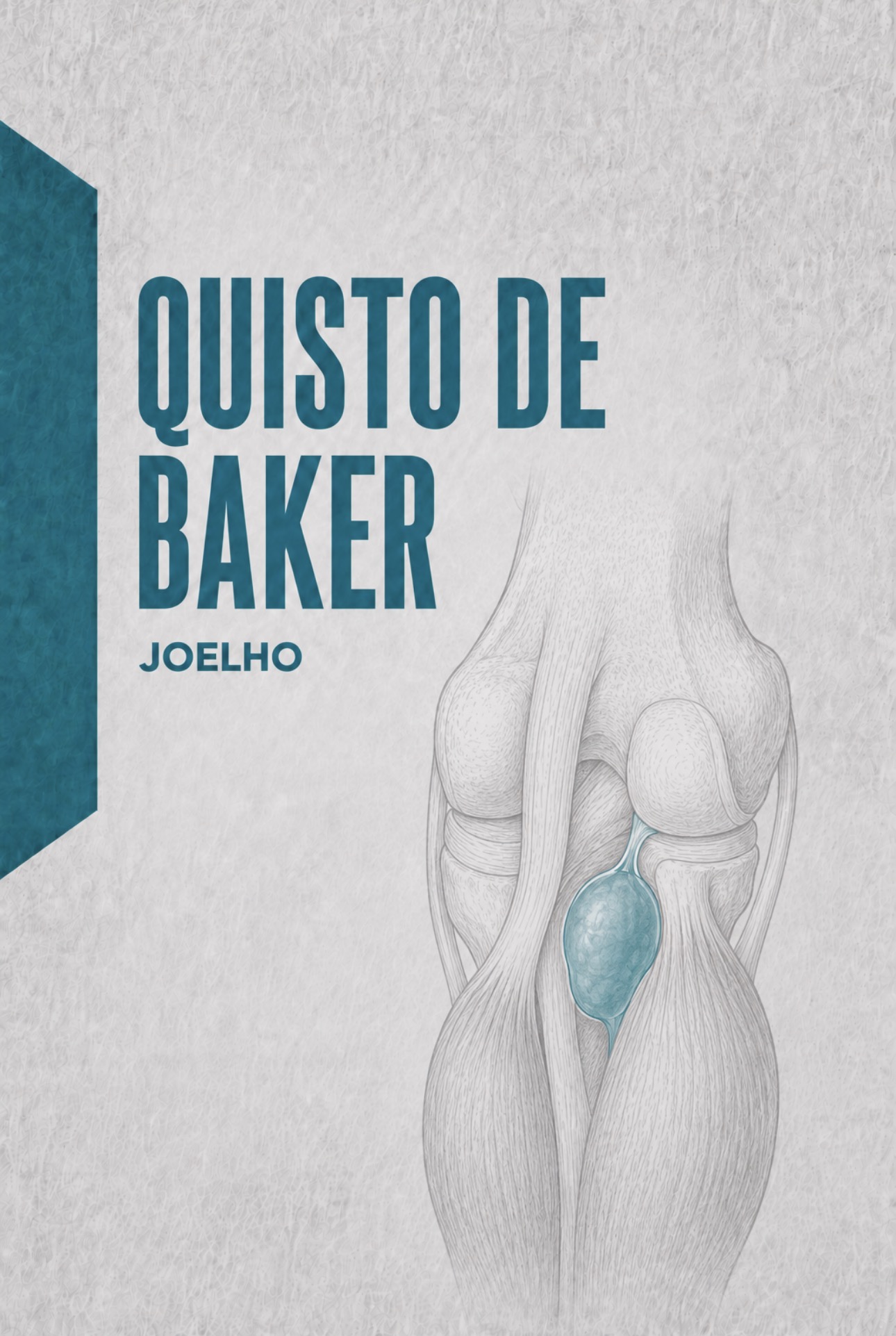 Ilustração médica do quisto poplíteo de Baker entre o gémeo medial e semimembranoso