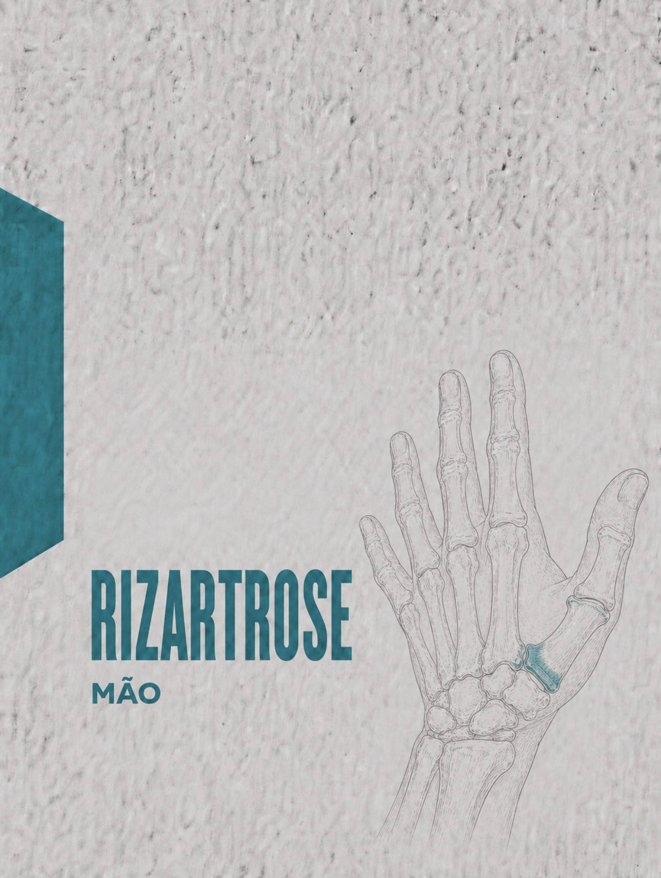 Ilustração médica de artrose da articulação trapézio-metacárpica na base do polegar (rizartrose)