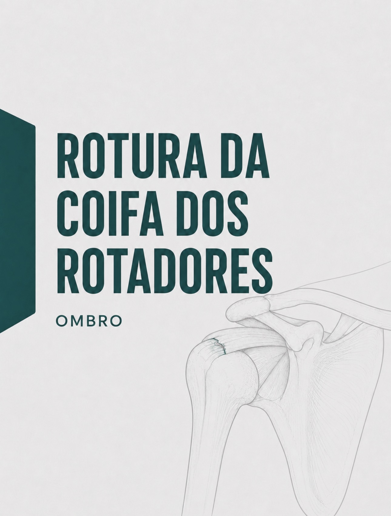 Ilustração médica de rotura de tendão da coifa dos rotadores