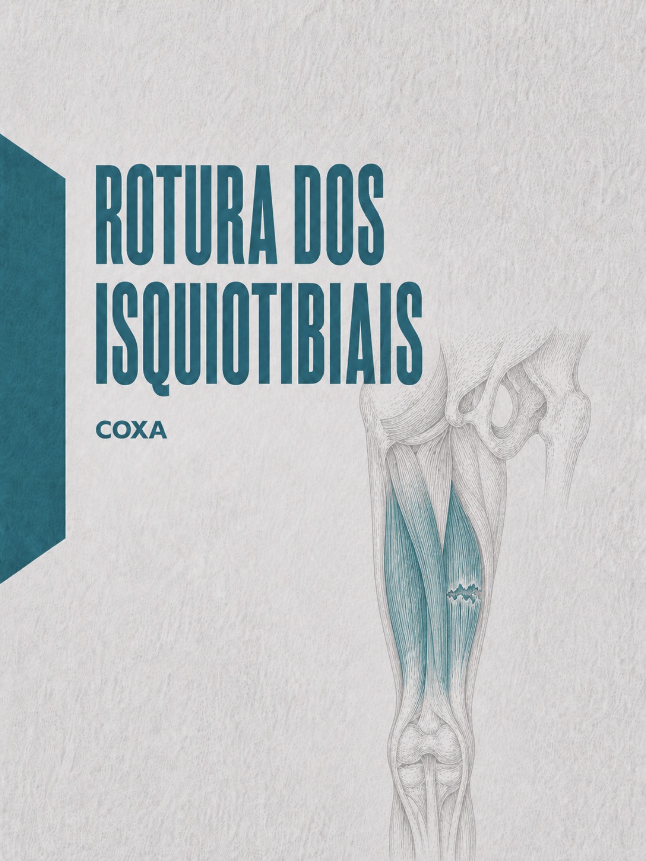 Ilustração médica da inserção dos tendões isquiotibiais na tuberosidade isquiática