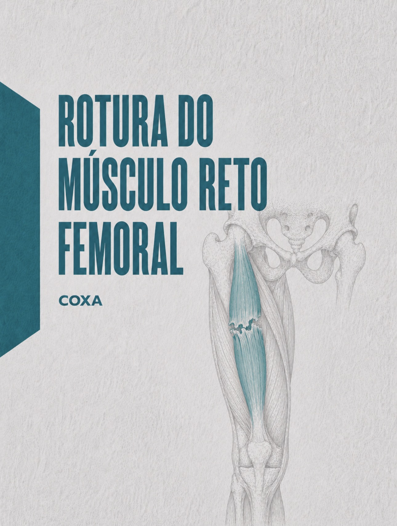 Ilustração médica do músculo reto femoral e tendão proximal na espinha ilíaca