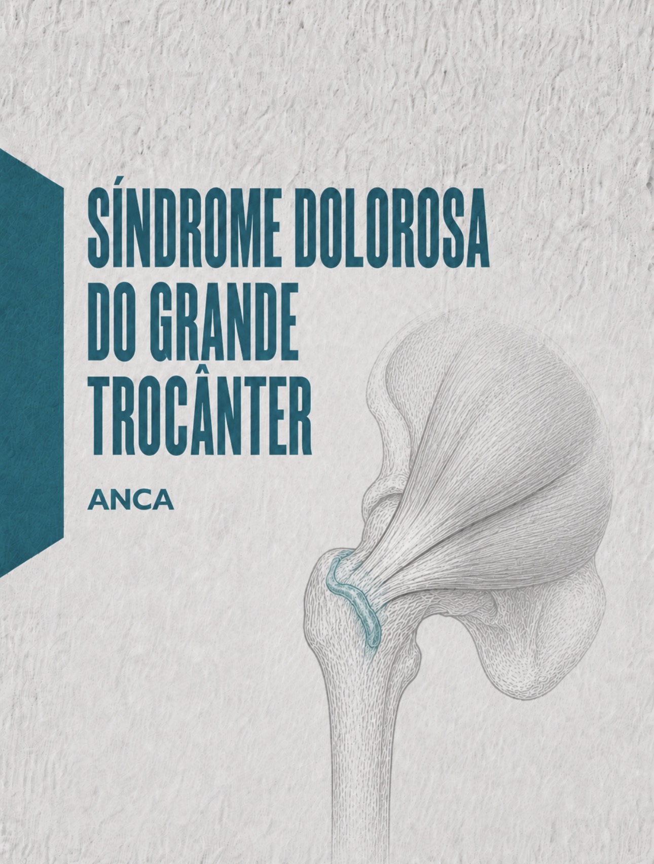 Ilustração médica dos tendões glúteos e bursa trocantérica no grande trocânter
