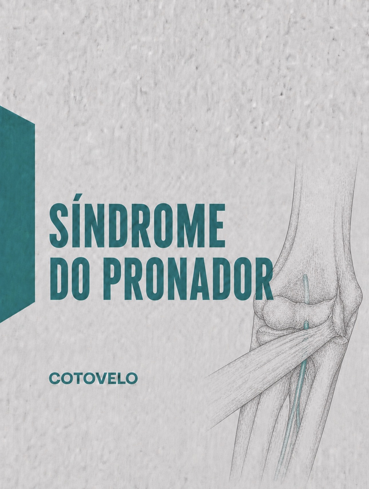 Ilustração médica de compressão do nervo mediano entre as cabeças do pronador redondo