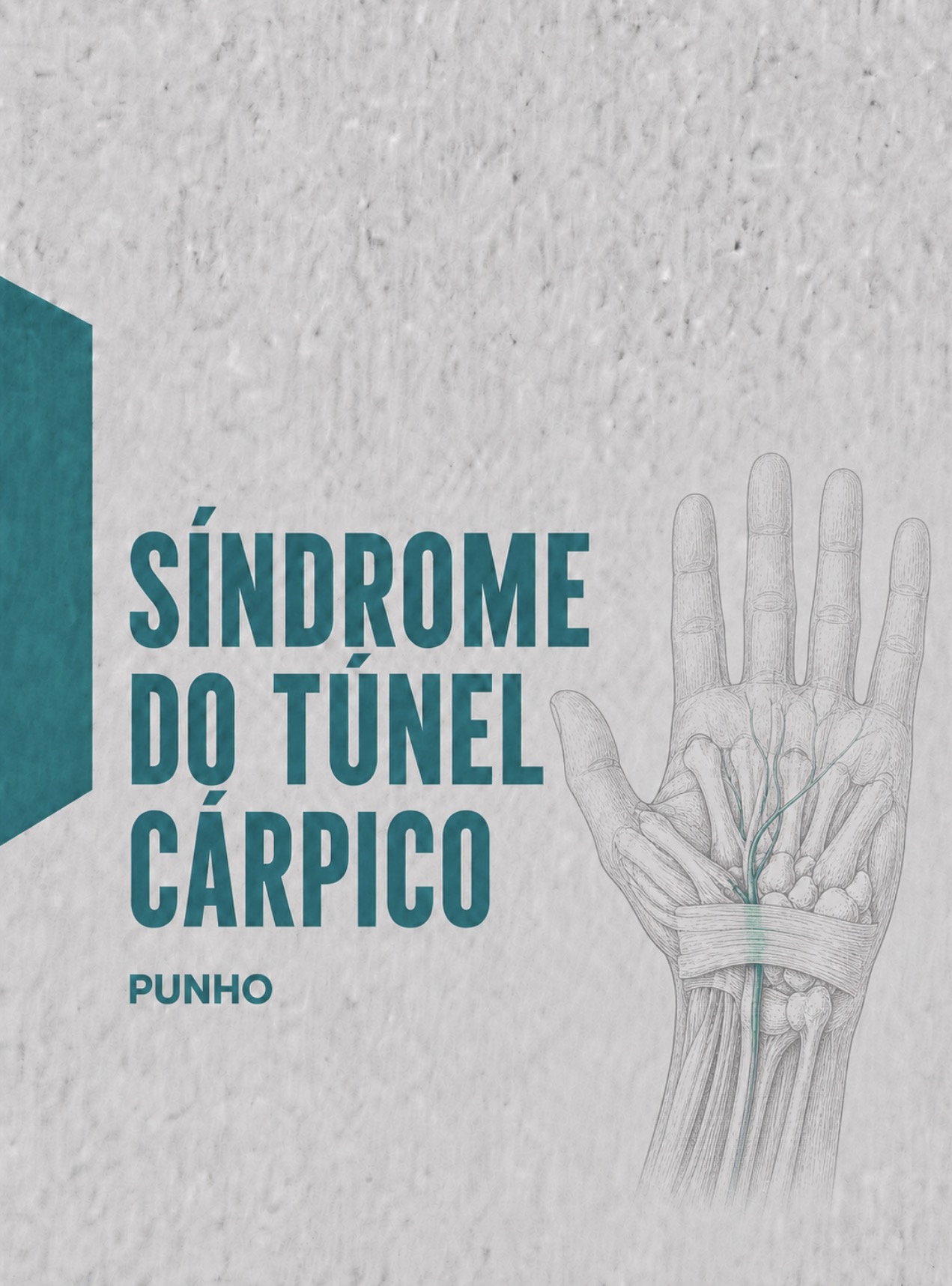 Ilustração médica da anatomia do canal cárpico e compressão do nervo mediano