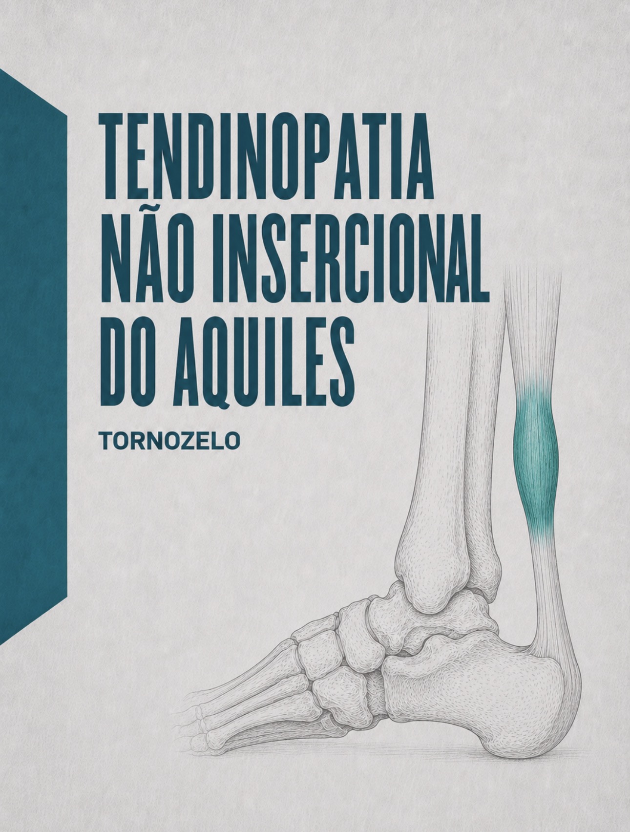 Ilustração médica da porção média do tendão de Aquiles (tendinopatia não-insercional)