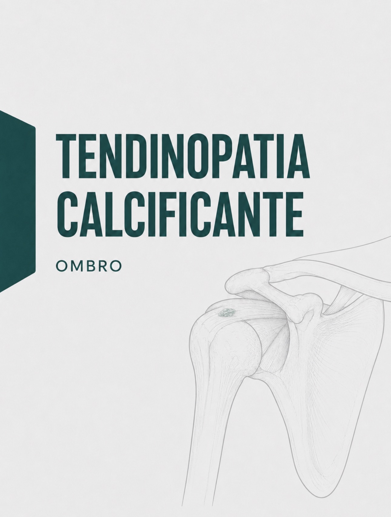 Ilustração médica de tendinopatia calcificante da coifa dos rotadores no ombro
