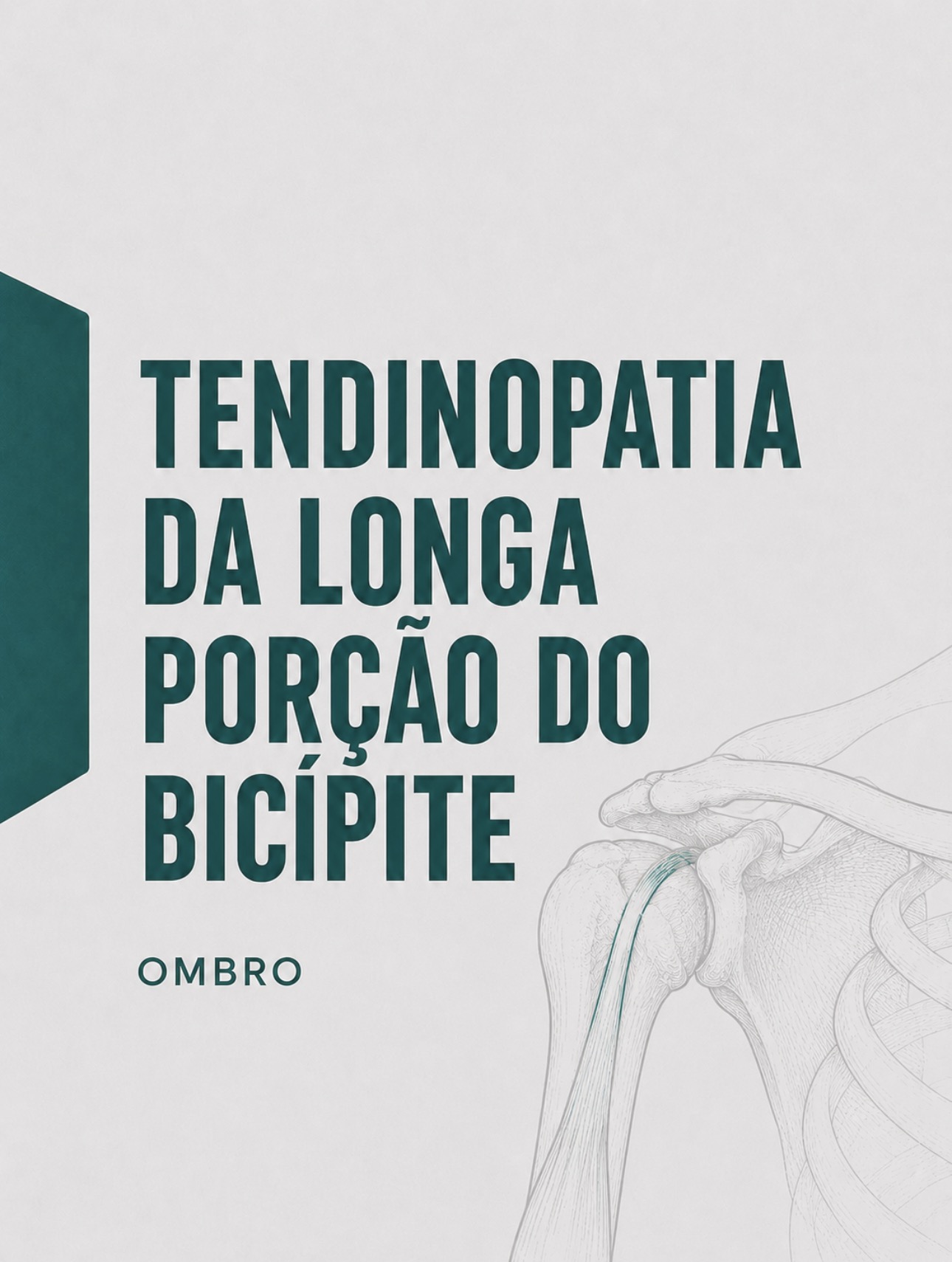 Ilustração médica de tendinopatia da longa porção do bicípite braquial na goteira bicipital
