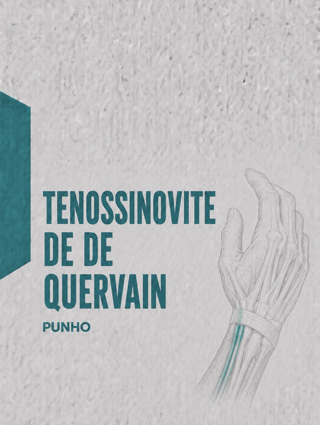Ilustração médica do primeiro compartimento extensor do punho na tenossinovite de De Quervain