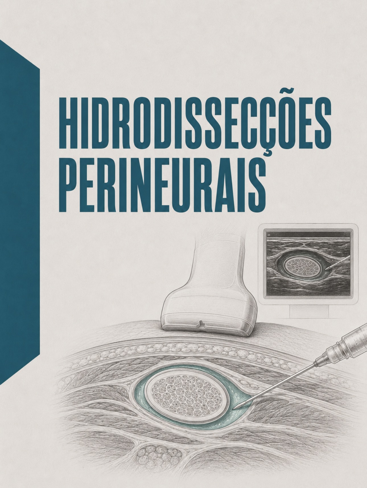 Ilustração clínica de hidrodisseção perineural com agulha sob controlo ecográfico