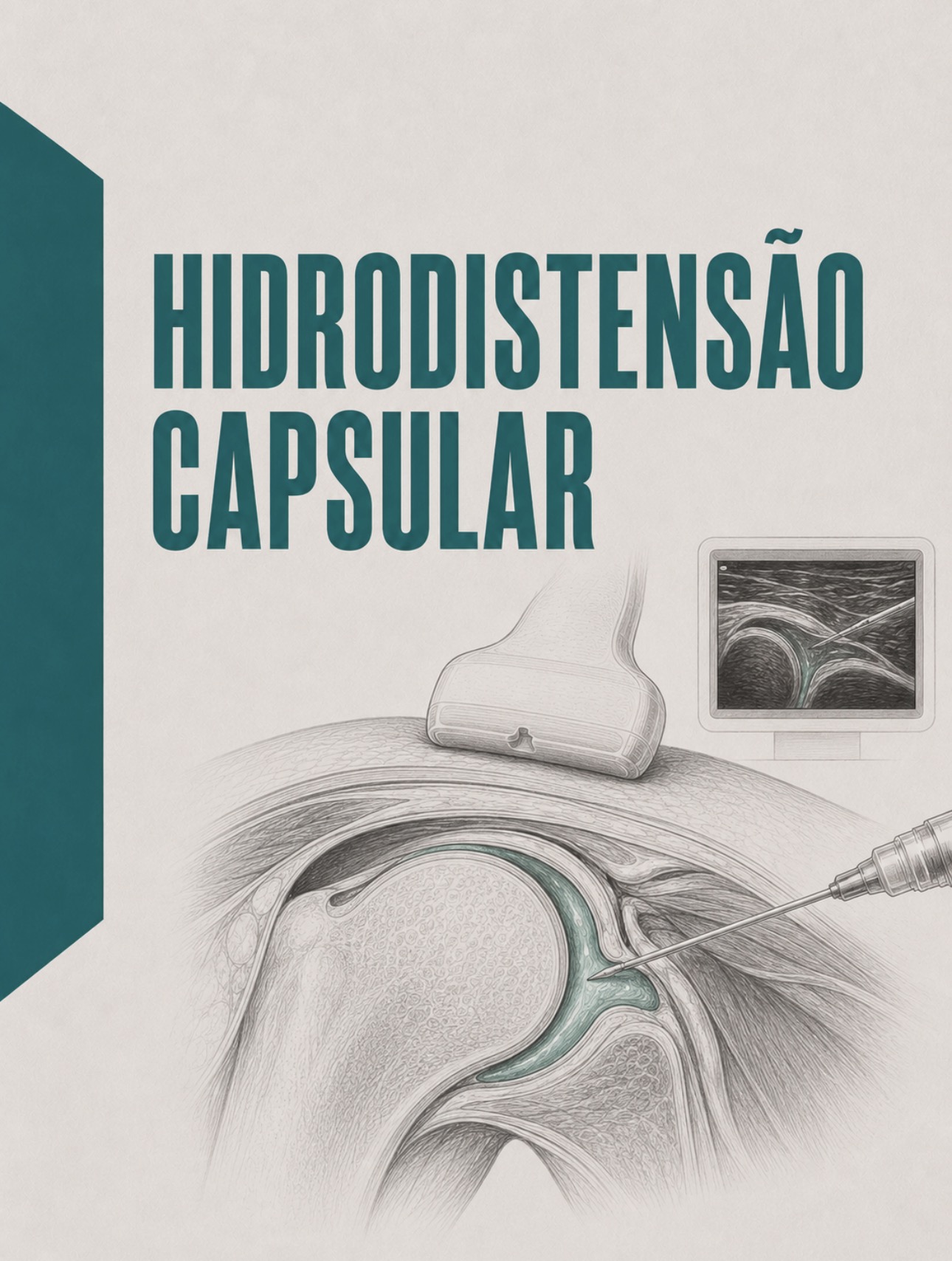 Ilustração clínica de hidrodistensão capsular guiada por ecografia