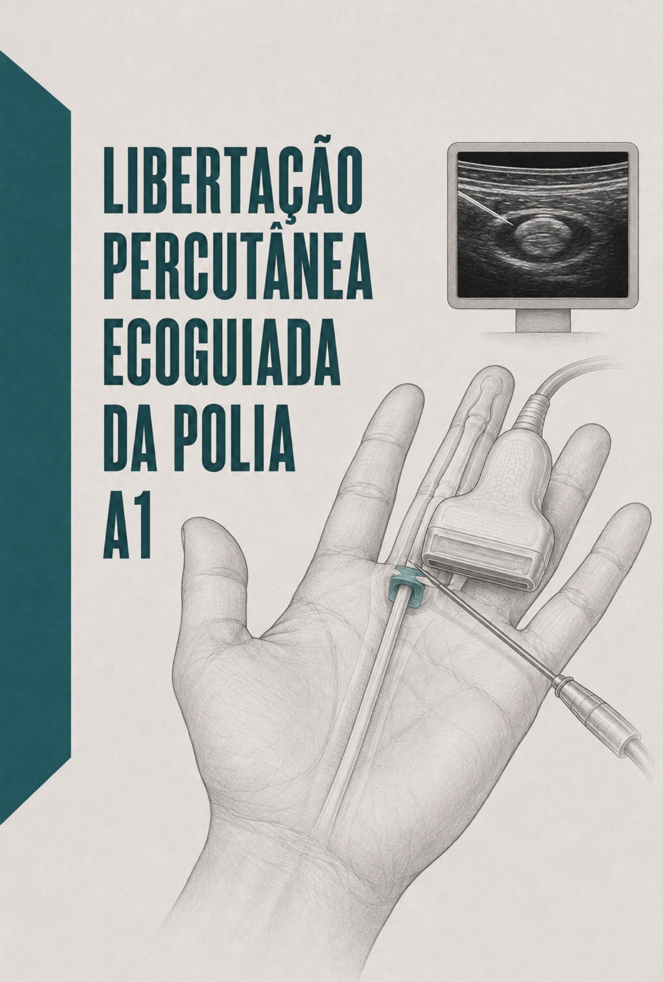 Ilustração clínica de libertação percutânea da polia A1 guiada por ecografia